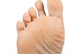 你的脚气总是反反复复？皮肤科医生：可能是因为没有对症治疗图片