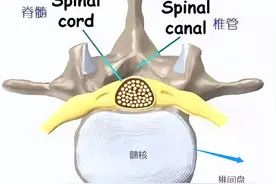突出的腰椎间盘自己还能缩回去吗？恐怕比中彩票还难图片