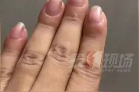 手指突然变粗大，竟是得了肺癌？专家：是真的，但没那么简单图片