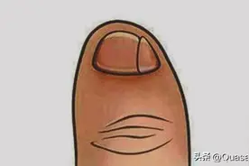 那些小脚趾分成两瓣的人真的是纯种汉族人吗？图片