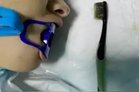 匪夷所思！浙江一女子刷牙漱口时，15厘米长的牙刷竟被吞入胃中图片