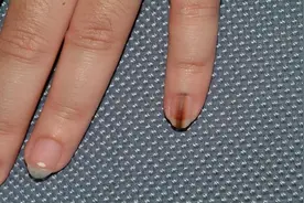 提醒：指甲若长成5种样子，可能是癌或疾病的信号，还请留心观察图片