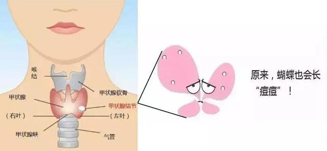 甲状腺结节二级会自愈吗 2026年甲状腺结节二级会消除吗