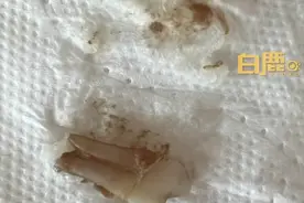 女子点外卖吃出1颗牙齿，当事人：像人的牙齿，已经报警；商家回应：我也很纳闷，不清楚牙是怎么来的图片
