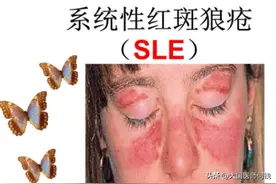 红斑狼疮与什么有关系？图片