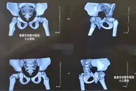 5岁孩子摔伤致股骨颈骨折！在儿童损伤中属罕见，术后并发症的发生率很高图片