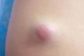褐色皮肤肿物，状似瘢痕，需要与一种皮肤恶性肿瘤鉴别图片