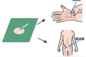 什么是冠脉造影？什么是PCI？什么是心脏支架植入图片