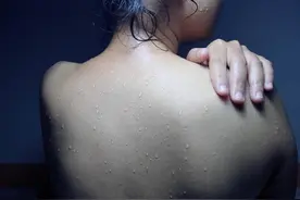 身体有病汗液先知，夏天爱出汗，或预示4种病，3个部位汗多要注意图片