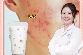 如果喝牛奶长痘痘，你还会喝吗？#痘痘 #喝牛奶 #医学科普 视频封面