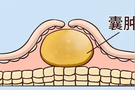 医生提醒：大多数囊肿无需处理，但若囊肿出现在3个地方，要重视图片