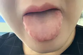 这几种舌苔，越补越上火你有吗图片
