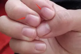 为什么，现在有很多，手指头上的白月牙消失了。图片