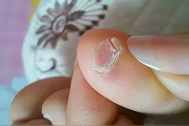 如果你的小脚趾有2瓣趾甲，可能不是纯正汉人，而是鲜卑族的后代图片