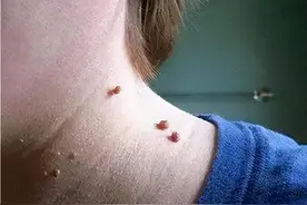 脖子和腋下的“小肉粒”是什么？可以直接用手揪掉吗？告诉你答案图片
