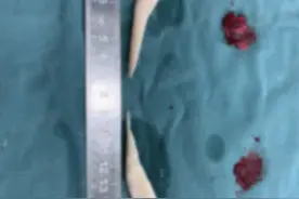 重庆肖林双侧下颌角截骨术咬肌部分切除外板磨削术筋膜固定缝合图片