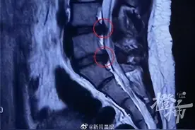13岁女孩坐姿不良致腰椎间盘突出图片