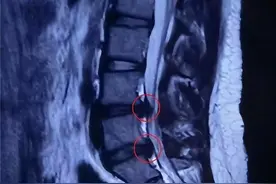 13岁女孩坐姿不良致腰椎间盘突出图片