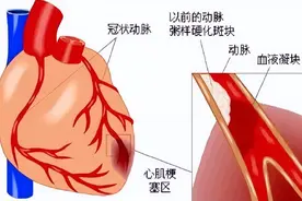 心脏支架术后，真的就“高枕无忧”了吗？图片