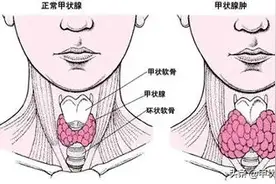 甲状腺知识大讲堂：有了甲状腺肿大，我们该怎么治疗？图片
