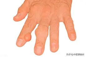 痛风反复，尿酸降不下去？3个中成药，横扫全身疼痛，远离痛风图片