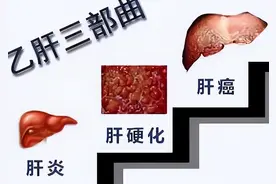 “小三阳”肝炎经过干扰素治愈后，还会复发吗？（上）图片
