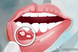 有一种痛，叫口腔溃疡：补充维C不顶用，用上3类药物更靠谱图片