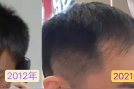 南京小伙走“头”无路花2万5植发，初见效果又担心只是昙花一现…图片