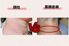 脖子黑洗不掉？松山医院：可能是黑棘皮病图片