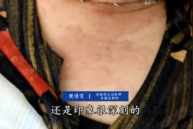 警惕！武汉女子喝水喝“毁容”，还有很多人在这样做图片