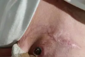 患者心脏起搏器外露，医生自制工具拔除用了23年的起搏器电极图片