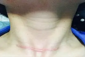 从“口腔”伸下去切甲状腺肿瘤？华西专家说，是的，你没看错！图片