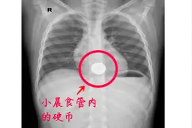 误吞硬币怎么办？深圳4岁男孩事后吃饭喝水竟惹大祸图片