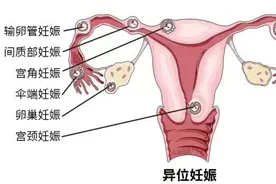 宫外孕：一场“错位的旅行”，如何安全返程？图片
