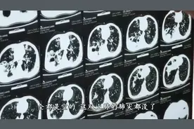 男子每天狂吸10包烟 双肺上半截“吸没了”图片