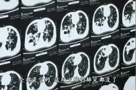 男子每天狂吸10包烟 双肺上半截“吸没了”图片