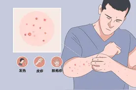 4人“亲密接触后感染猴痘”，这次毒株有何特点？中疾控提醒→图片
