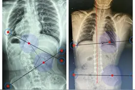 62°变仅6°，得了罕见病得她长高2厘米！专家徒手植入14枚螺钉拉直变形脊柱图片
