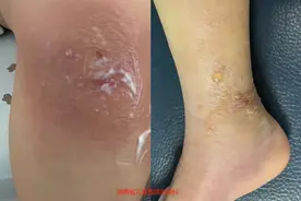 半个月收治两百多例！保护你家娃娃远离“虫咬性皮炎”图片