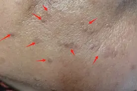 千万别抠！身上长的这种小疙瘩或是HPV病毒感染，越抠越多图片