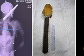 颌面颈钢筋贯穿伤救治！齐鲁医院多学科联合过危重症复合创伤救治难关图片