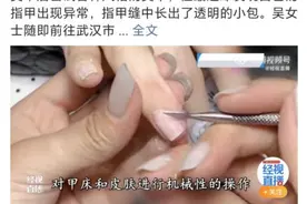 频繁美甲后指缝长出菜花，又是因为它！治疗方法帮你总结全了图片