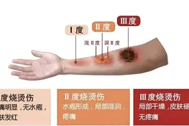 别再抹牙膏、酱油、白酒了！烫伤急救“五字诀”了解一下图片