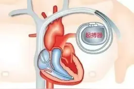 安装了心脏起搏器要注意这些 千万别做错图片