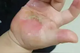 痛！重庆幼童被滑梯烫伤，手掌皮肤像“被融了”！高温天警惕→图片