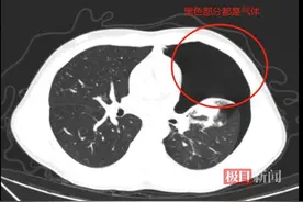 14岁少年跑步后突发气胸，左肺竟被压缩50%，医生紧急“排气”化险为夷图片