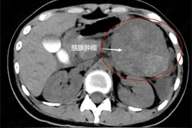 19岁女生突发腹痛危及生命，这种胰腺肿瘤好发于年轻女性图片