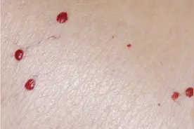 揭秘皮肤上红色小点点的秘密图片