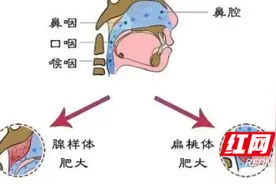 「甘货」儿童扁桃体肥大，要不要手术？图片