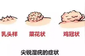 45岁男子生殖器长出“菜花”，在医院他懊悔不已：几年前为何不重视！图片